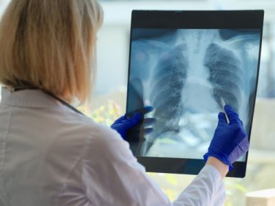 A person in a white coat looks at an xray of a rib cage and lungs.